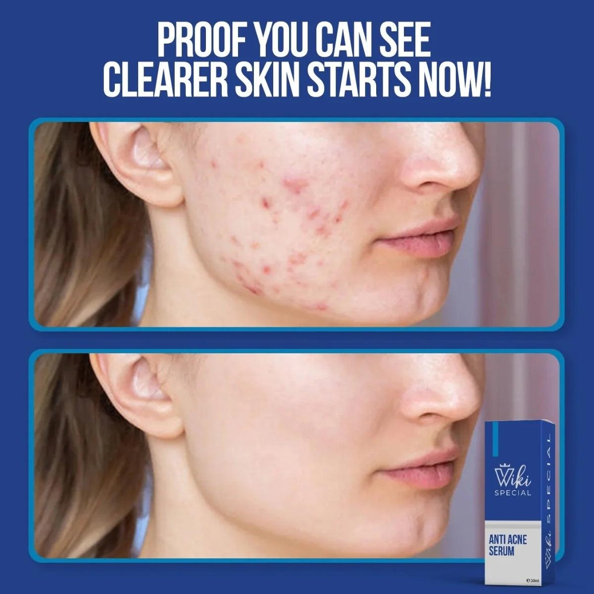 Wiki Special Anti Acne Serum 30ml | Clears Acne & Soothes Skin (IMPORTED)