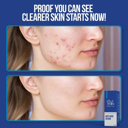 Wiki Special Anti Acne Serum 30ml | Clears Acne & Soothes Skin (IMPORTED)